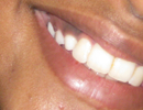 dental implants & dentures